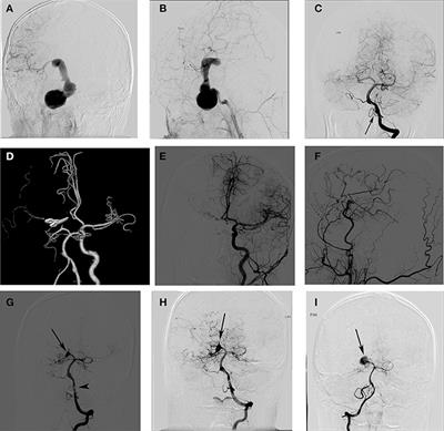 Paediatric Intracranial Aneurysms: Long-term Angiographic and Clinical Outcomes in a Contemporary Series